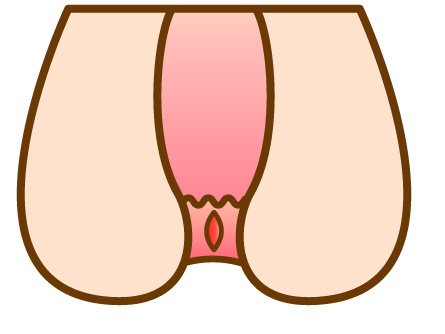 切れ痔(裂肛)
