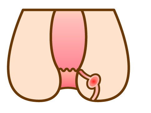 あな痔(痔ろう)