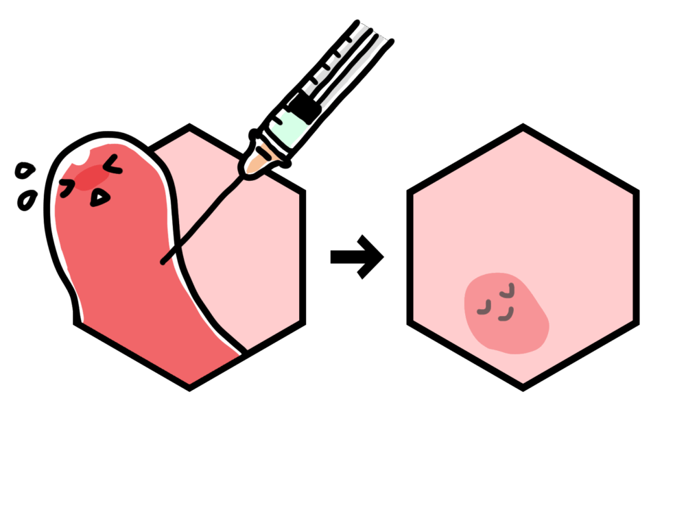ジオン注射療法