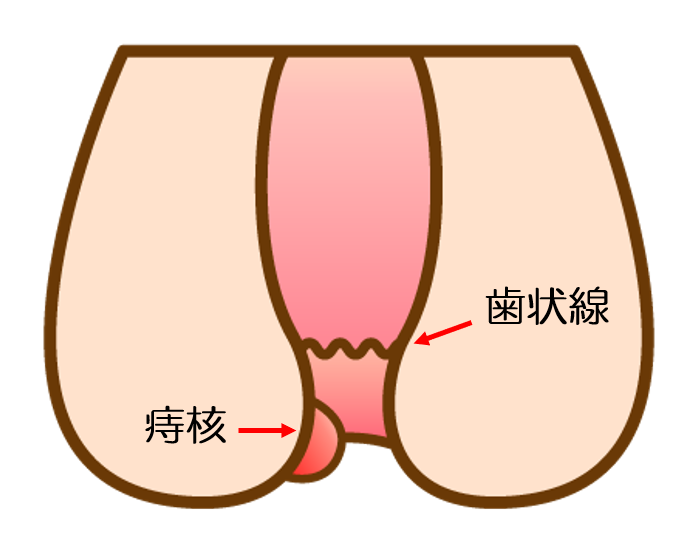 外痔核(肛門の外側にできるいぼ痔)