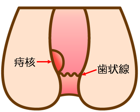内痔核(肛門の内側にできるいぼ痔)