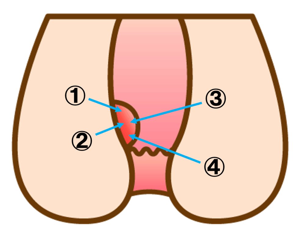 ジオン注射の4段階の投与方法