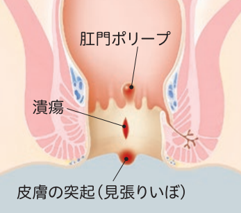 慢性化した切れ痔
