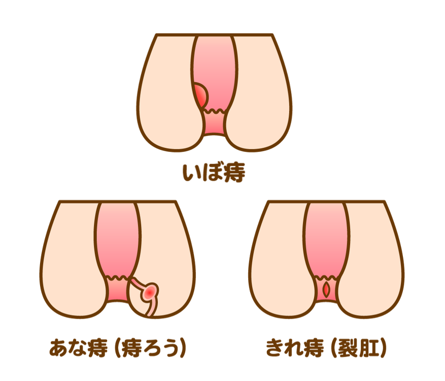 痔の種類（いぼ痔・あな痔・切れ痔）