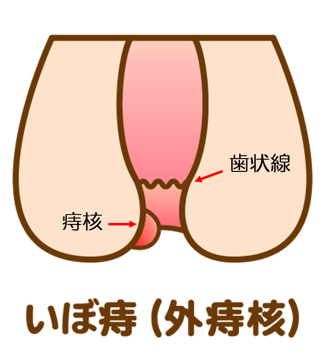いぼ痔（外痔核）
