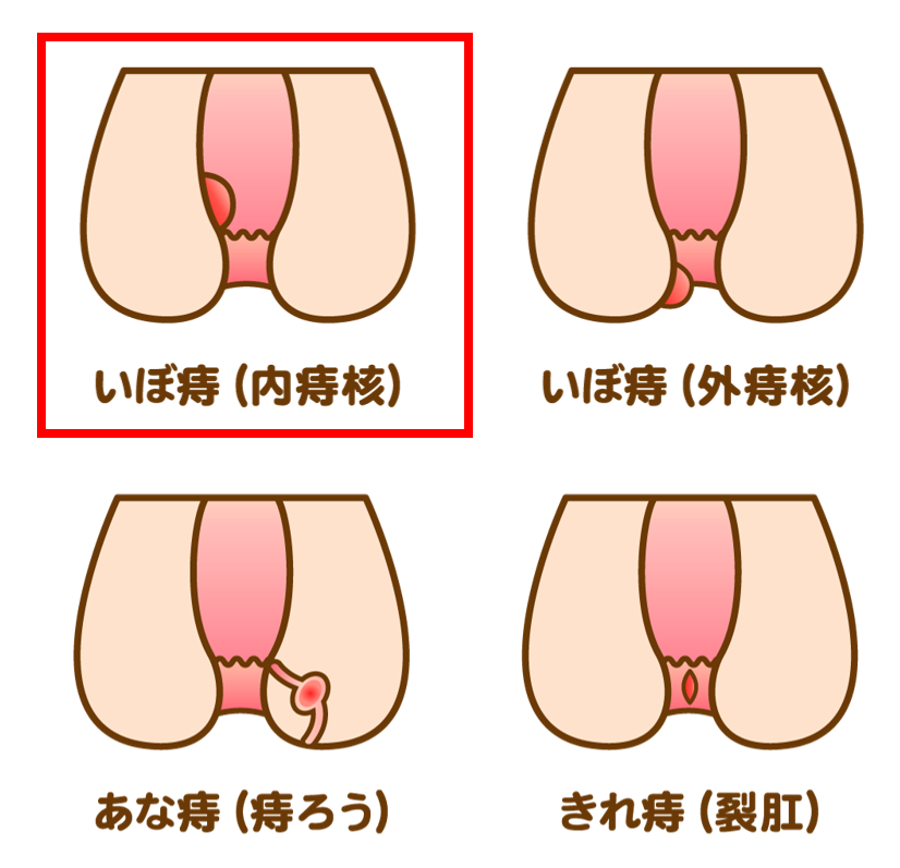 ジオン注射が適応となる痔の種類